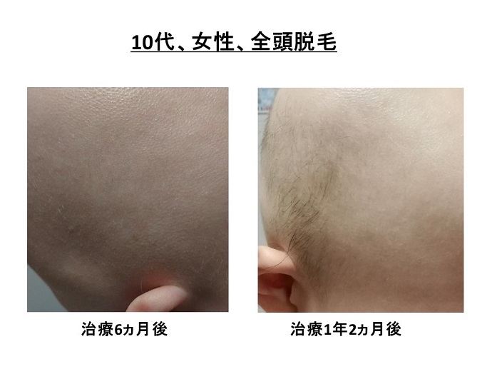 円形脱毛症　病院